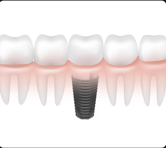 Best Dental Implant Specialist in South Mumbai
