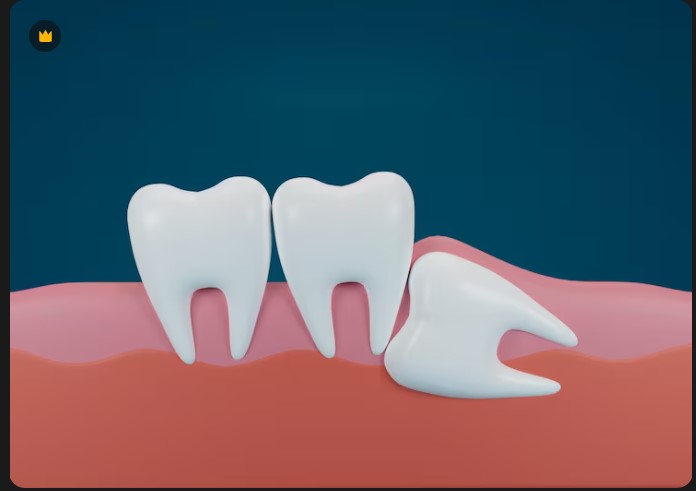 Best Wisdom Tooth Surgery in South Mumbai